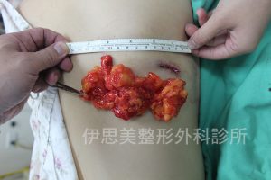 微創脂肪瘤手術-伊思美整形外科診所, 台中脂肪瘤切除